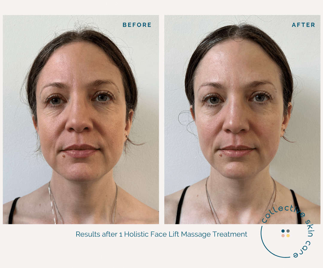 Quarterly facial progress photos documenting roller use