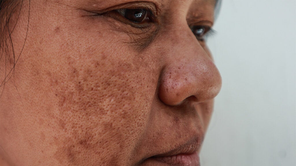A woman's face with melasma patches on the cheek