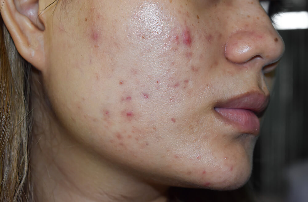 A face with post-acne red marks and one shallow atrophic scar