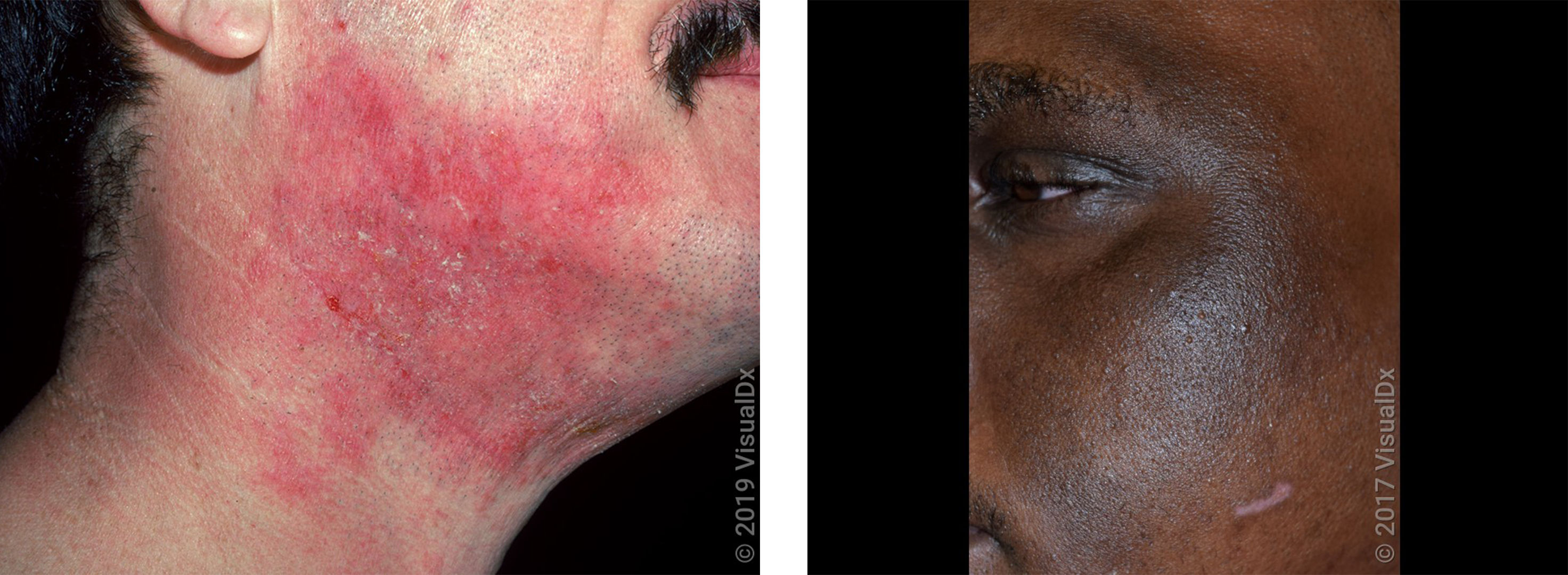 A face with eczema patches on the cheeks and forehead