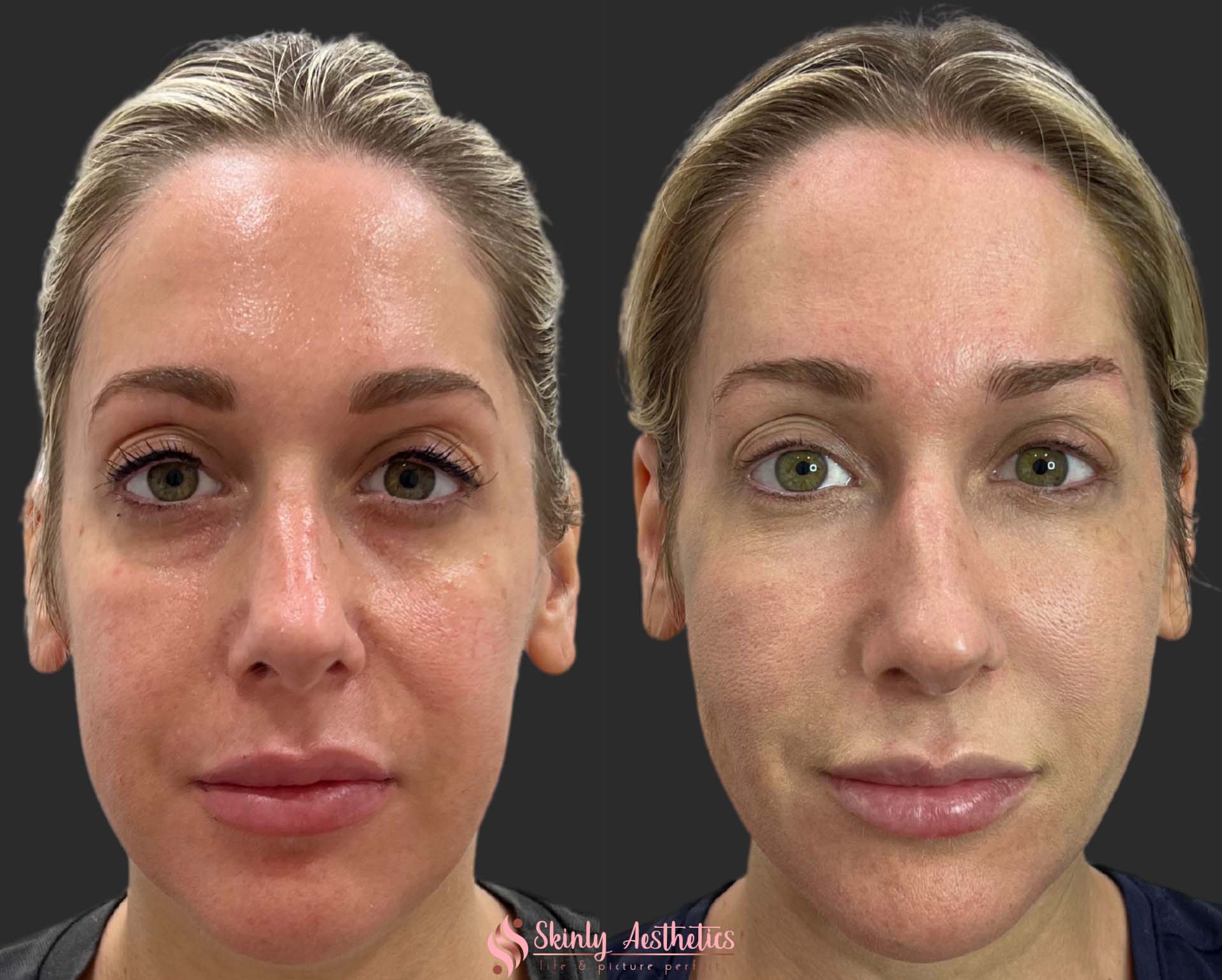 hyaluronic acid face treatment