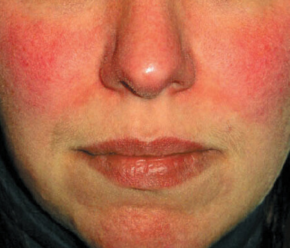 Jade Roller and Rosacea: A Reactive-Skin Walkthrough